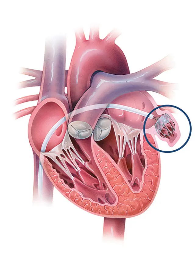 Types of left atrial appendage